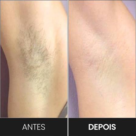 DEPILADOR LASER IPL PERMANENTE